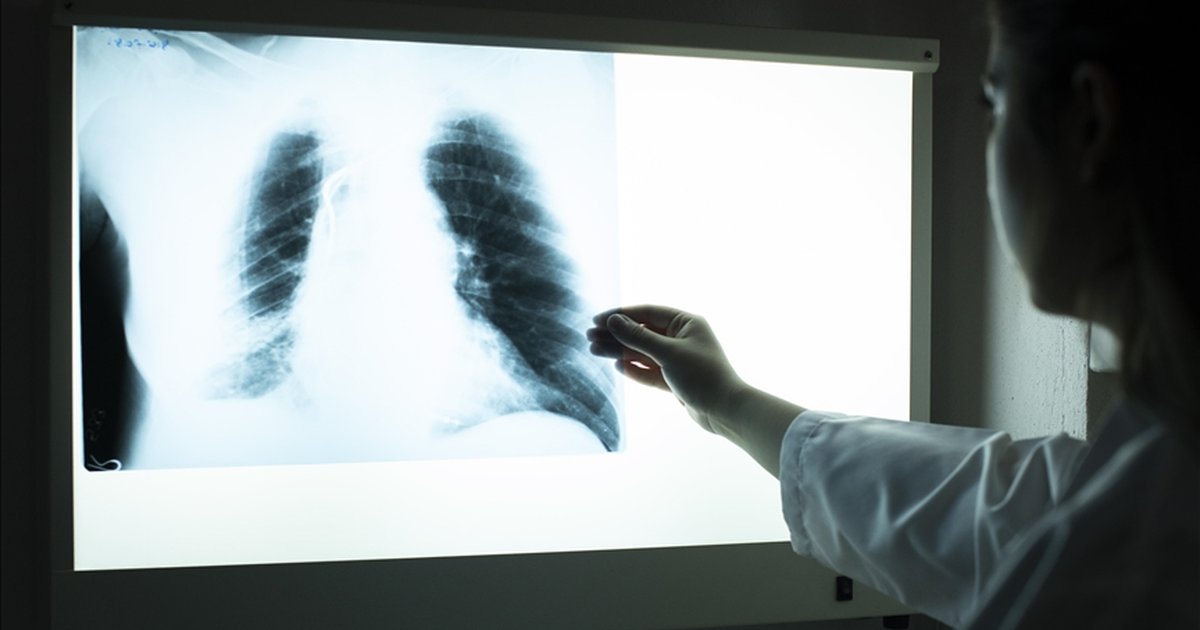 Tüberküloz: Dünyada Yılda 10 Milyon Kişi Hastalanıyor