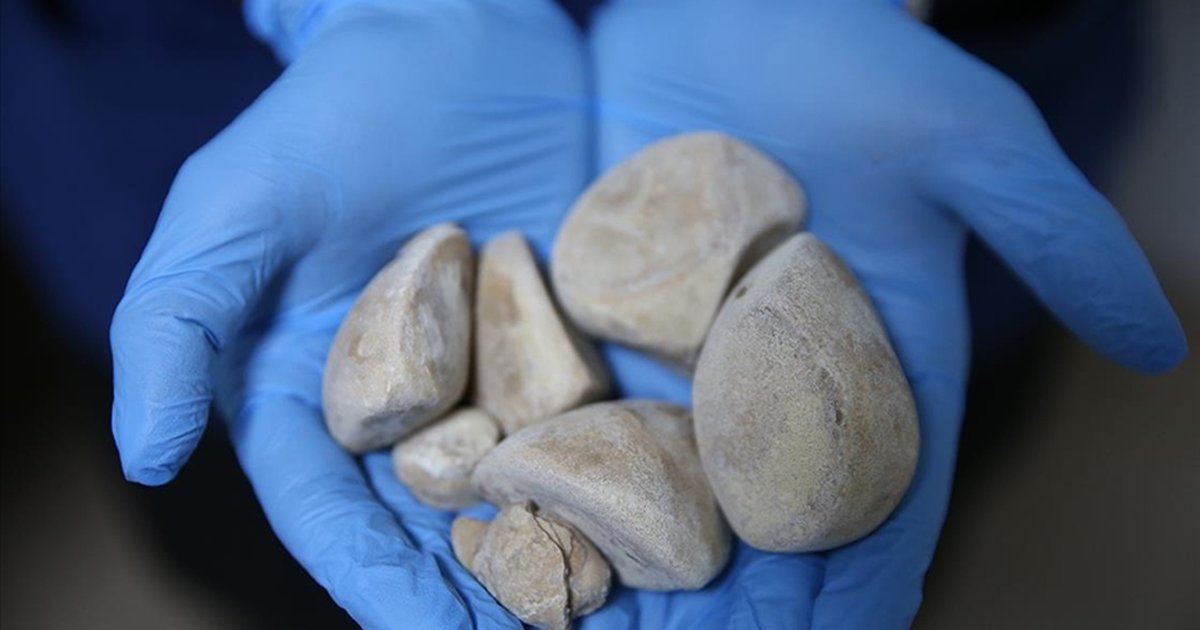 Diyarbakır'da kadının idrar kanalından 6 taş çıkarıldı